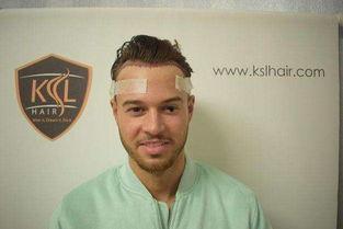 植发的明星网红,明星植发前后对比大揭秘！”