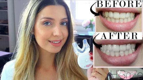 明星网红牙齿美白,明星网红牙齿美白秘籍大公开！